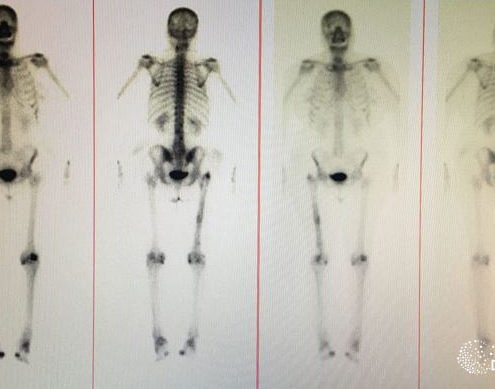 gammagrafía ósea - Dr Roberto Vélez