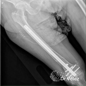 Fractura patológica- metástasis óseas- Dr Roberto Vélez