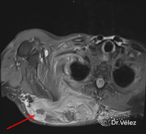 Síntomas Tumores Malignos de Partes Blandas -Sarcomas de Partes Blandas- Dr Roberto Vélez