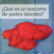 sarcoma tejido blando_ dr roberto vélez