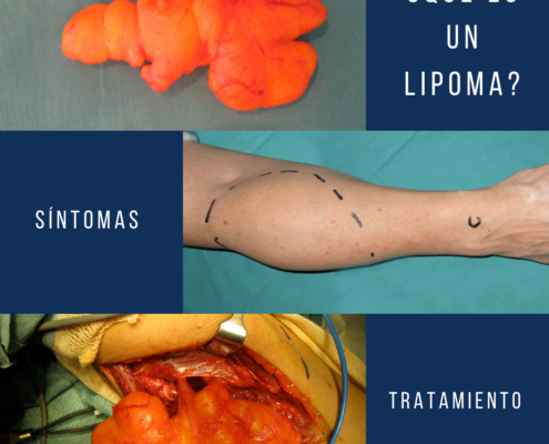 ¿Qué es un lipoma?