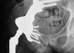 condrosarcoma
