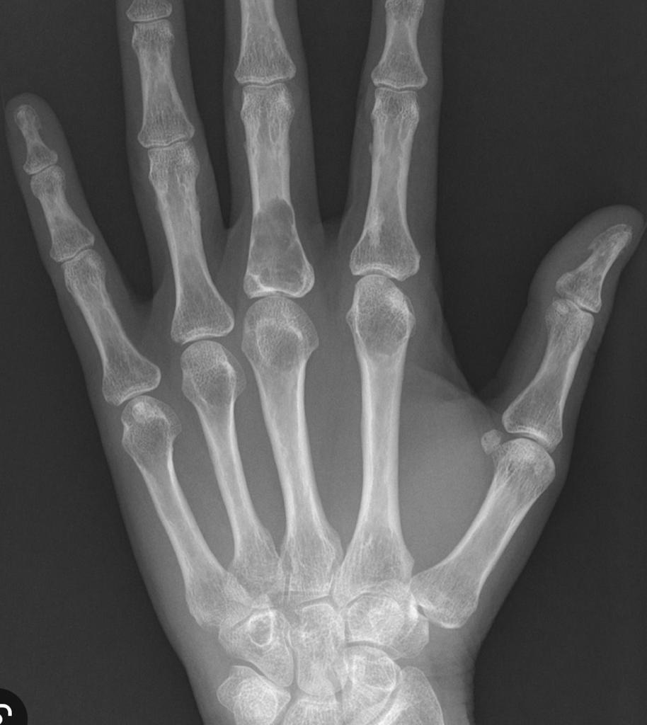 Encondroma de mano en falange proximal dedo medio