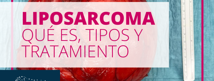 liposarcoma