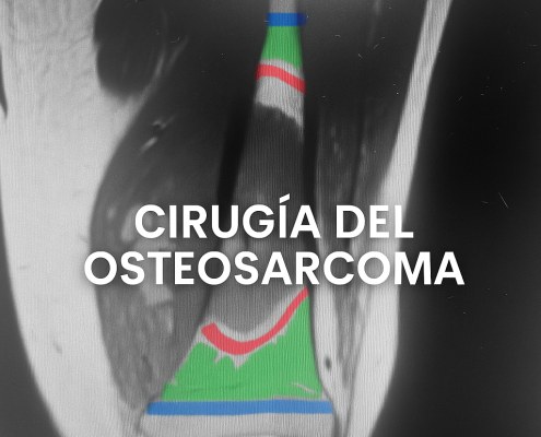 Cirugia del Osteosarcoma