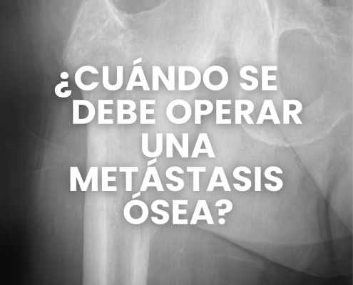 Cuando se debe operar una metástasis ósea